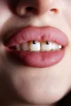 Smiley Piercing Healing Time & Aftercare Guide